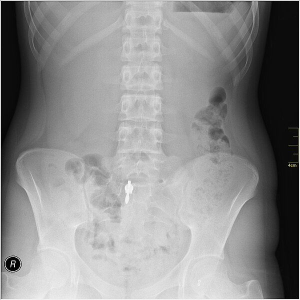 File:Medical X-Ray imaging PHZ06 nevit.jpg