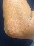 Paucibacillary leprosy (PB): Maputlang patse-patse sa balat na nawalan ng pakiramdam