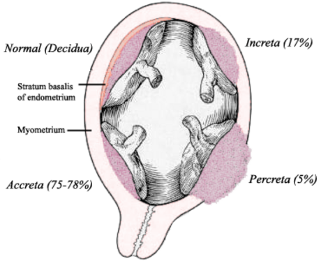 Placenta accreta spectrum