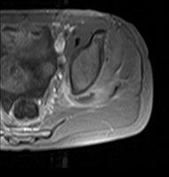 Axial T1 weighted fat suppressed post IV gadolinium contrast enhanced MRI image showing a mutliloculated bacterial abscess in the left gluteal muscle which grew Staphylococcus aureus (methicillin sensitive) thought to be due to tropical pyomyositis.