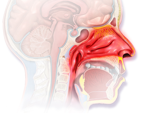 Blausen 0015 AllergicRhinitis