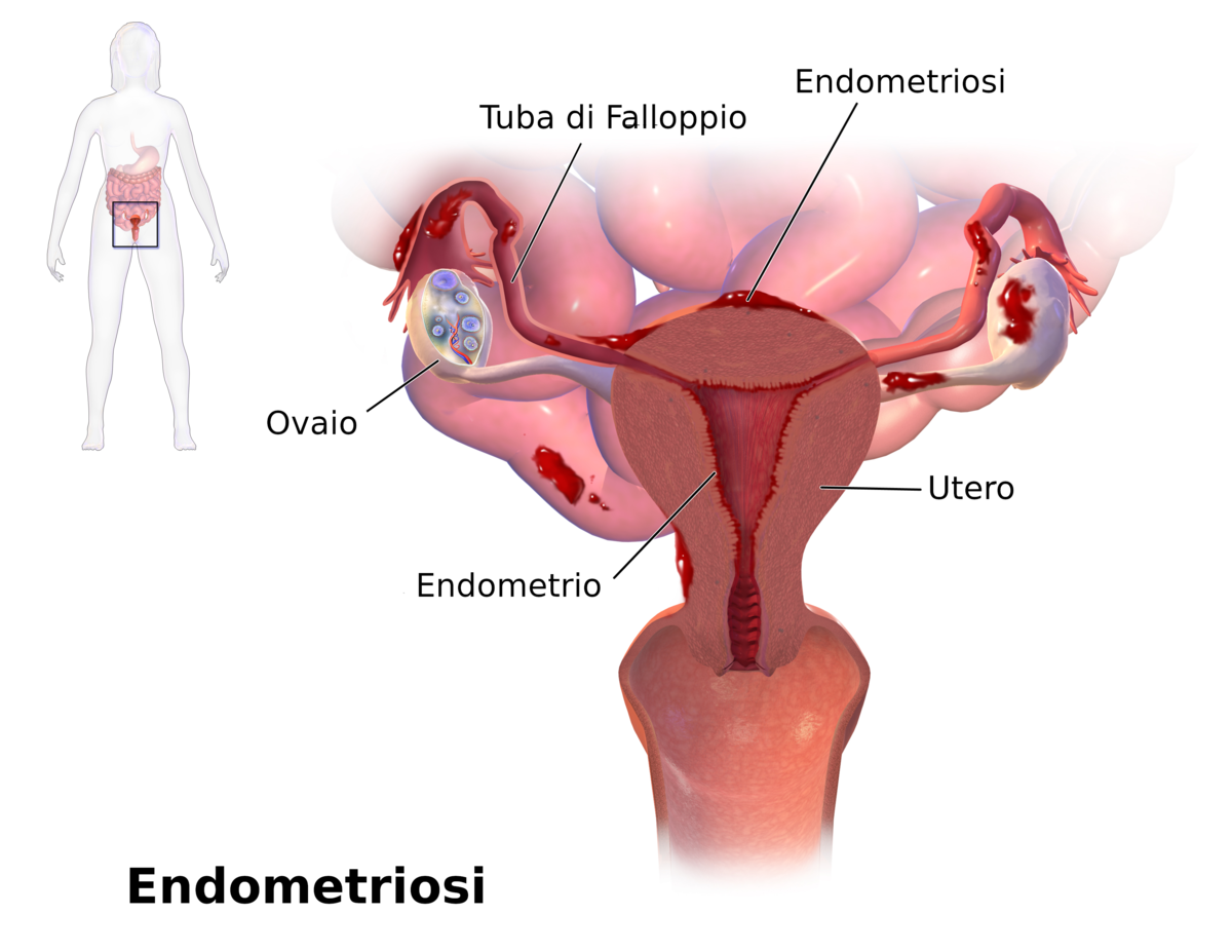 Endometriosi Wikipedia