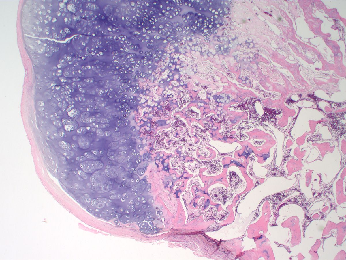 Osteochondroma