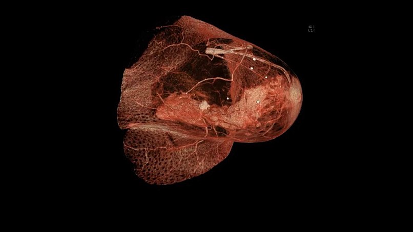 Tumour in the breast visualized by Breast-Computertomography (Breast-CT)