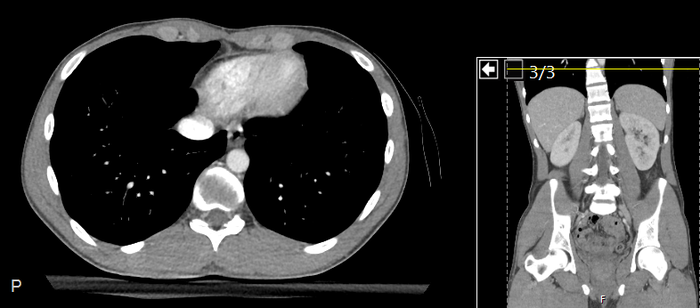 CT of a normal abdomen and pelvis, axial plane 15.png