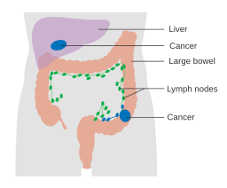 File:Diagram 1 of 2 showing stage 3B breast cancer CRUK 004.svg - Wikipedia