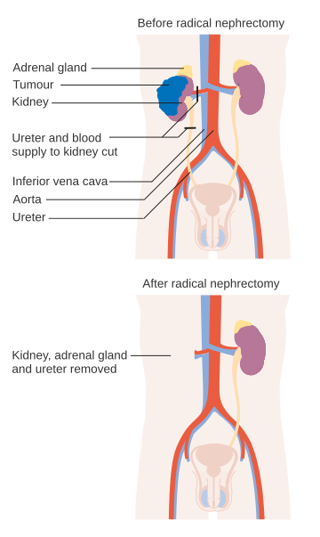 Nephrectomy