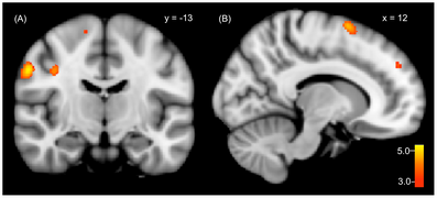 Dissociative identity disorder neuroscience brain imaging (no description).png