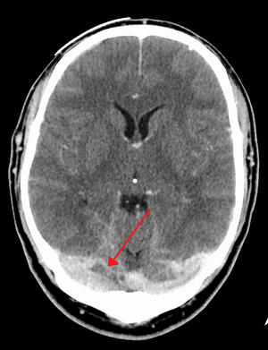 Cerebral Venous Sinus Thrombosis