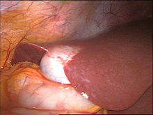 Gallbladder in laparoscopy.jpg