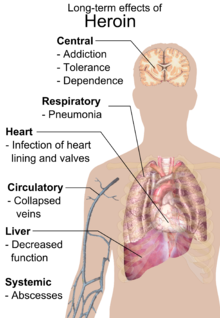 Long-term effects of intravenous usage, including - and indeed primarily because of - the effects of the contaminants common in illegal heroin and contaminated needles. Long-term effects of heroin.png