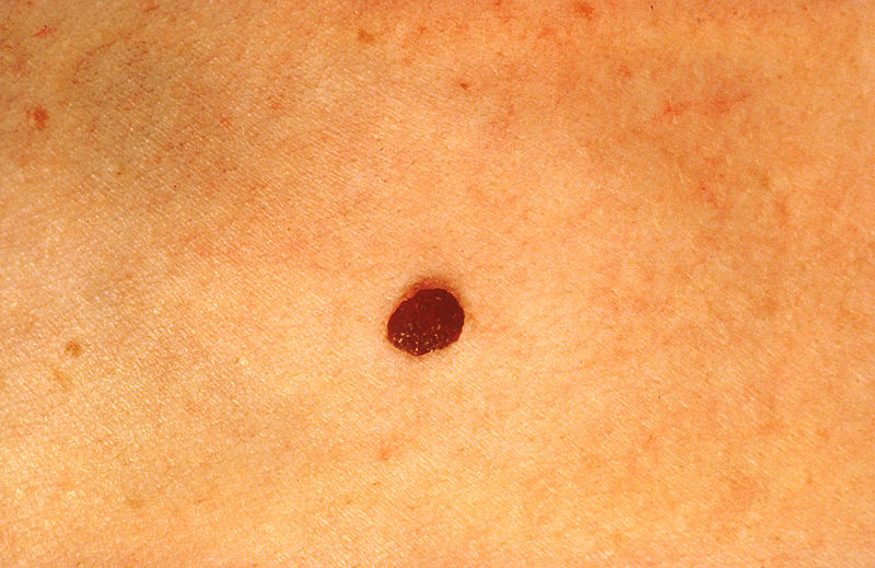 File:Normal mole with no color differences.jpg