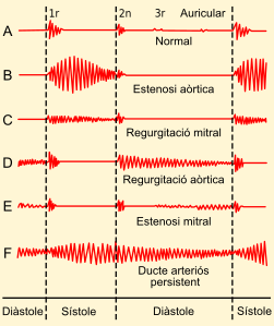 Phonocardiograms from normal and abnormal heart sounds-ca.svg