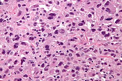 Pleomorphic undifferentiated sarcoma - very high mag