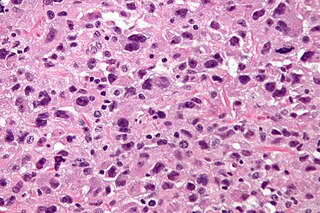 <span class="mw-page-title-main">Undifferentiated pleomorphic sarcoma</span> Medical condition