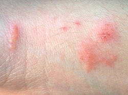 Poison ivy contact dermatitis.jpg