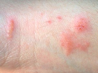 Urushiol-induced contact dermatitis Medical condition