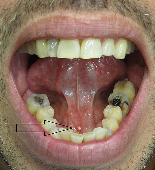 Salivary stone in submandibular salivary duct