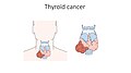 Thyroid cancer