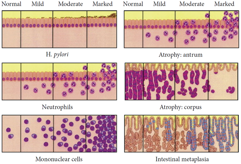 File:Updated Sydney System for visual classification of gastritis.png