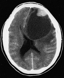 405663-PLEOMORPHIC XANTHOASTROCYTOMA.jpg