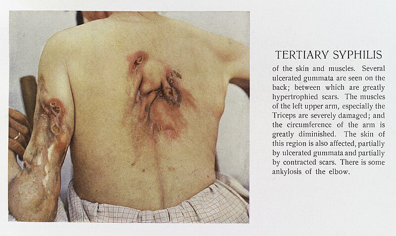 File:A case of tertiary Syphilis to the back Wellcome L0038264.jpg