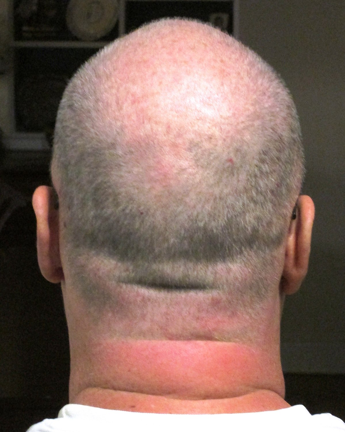 File Back Of Man S Head Plus 7 Years And 7 Months Jpg Wikimedia Commons