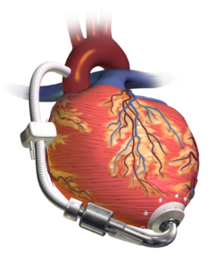 補助人工心臓 Wikipedia