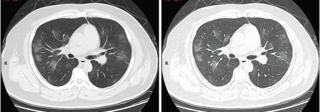 Contoh hasil temuan penyakit dari pencitraan tomografi terkomputasi (CT scan)