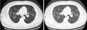 Typical CT imaging findings