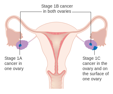File:Diagram showing stage 1 ovarian cancer CRUK 193.svg