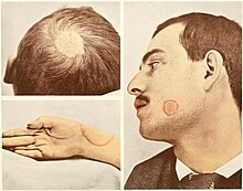 Fungal infection on a man's hand. Tinea manuum and close-up view of  dermatophyte fungi Stock Illustration