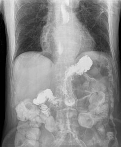 Gastroesophageal reflux barium X-ray.jpg