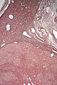 Micrograph of hepatic adenoma. Reticulin stain