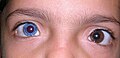 إنسان ذي عيون شاذَّة مع تأثير العين الحمراء في عينه الزَّرقاء