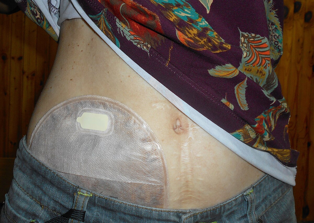 Closed Ostomy Pouch vs Drainable Ostomy Pouch