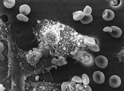 Macrophages have identified a cancer cell (the large, spiky mass). Upon fusing with the cancer cell, the macrophages (smaller white cells) inject toxins that kill the tumor cell. Immunotherapy for the treatment of cancer is an active area of medical research.[139]