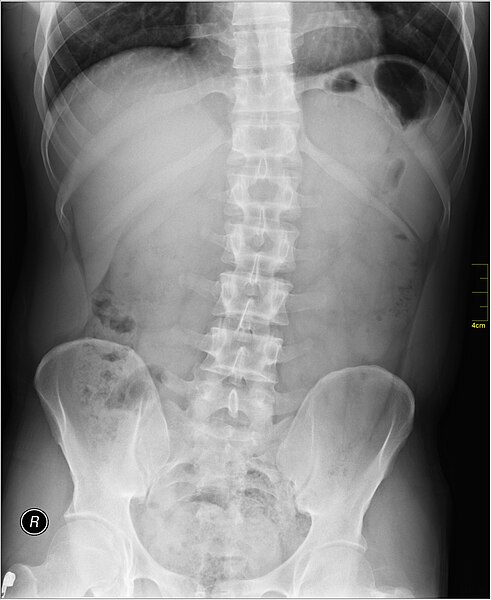 File:Medical X-Ray imaging DEY03 nevit.jpg