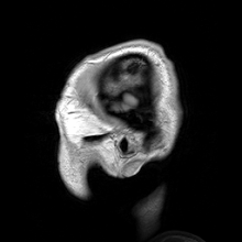 Parasagittal MRI of human head in patient with benign familial macrocephaly prior to brain injury (ANIMATED).gif