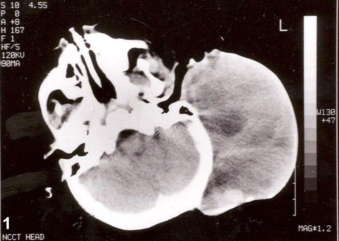 Rhabdomyosarcoma