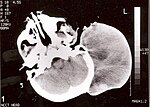 Thumbnail for Rhabdomyosarcoma