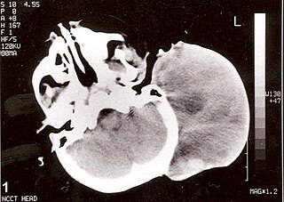 Rhabdomyosarcoma