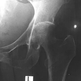 Septic arthritis of left hip joint with melioidosis.jpg