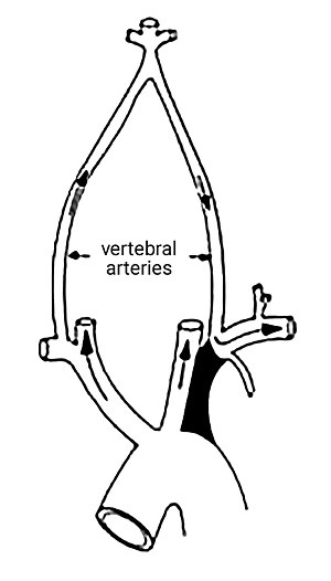 The promixal part of left subclavian is blocked on left side so no flow in vertebral and to left arm-blood from right vertebral enters left vertebral and flows back to supply left arm 2013-07-05 17-11.jpg