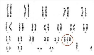 Edwards syndrome Chromosomal disorder in which there are three copies of chromosome 18
