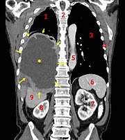 Tumora Mesothelioma2-legend.jpg