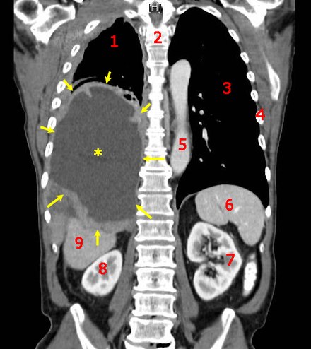 CT scan of a patient with mesothelioma, coronal section (the section follows the plane that divides the body in a front and a back half). The mesothelioma is indicated by yellow arrows, the central pleural effusion (fluid collection) is marked with a yellow star. Red numbers: (1) right lung, (2) spine, (3) left lung, (4) ribs, (5) descending part of the aorta, (6) spleen, (7) left kidney, (8) right kidney, (9) liver.