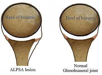 ALPSA Lesion.jpg