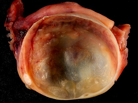 A simple ovarian cyst of most likely follicular origin