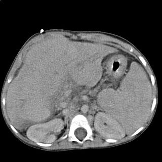 CT abdomen - liver cirrhosis - 01.JPG